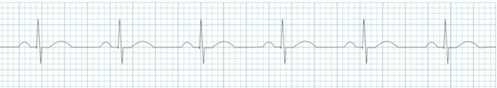 phức bộ QRS nhịp hẹp