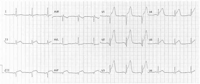 STEMI thành trươc – thành dưới