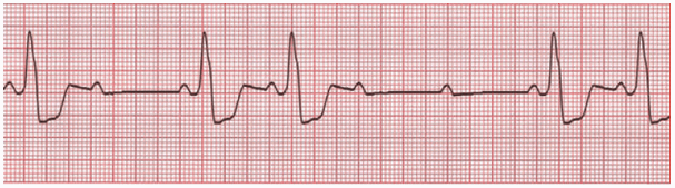 Liên tục các sóng P không dẫn mà không kéo dài tiến triển của khoảng PR