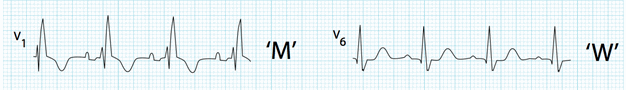 Block nhánh phải (RBBB)