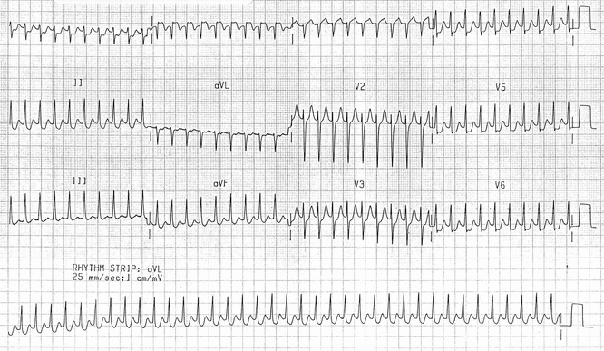 QRS hẹp vì xung đang được truyền theo hướng orthodromic