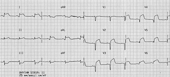 STEMI trước bên