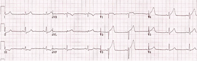 STEMI trước bên cấp tính