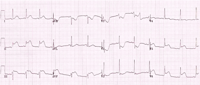 STEMI dưới bên