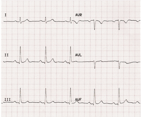 ECG cơ bản