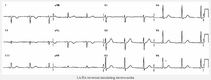 Đảo chiều LA / RA mô phỏng dextrocardia