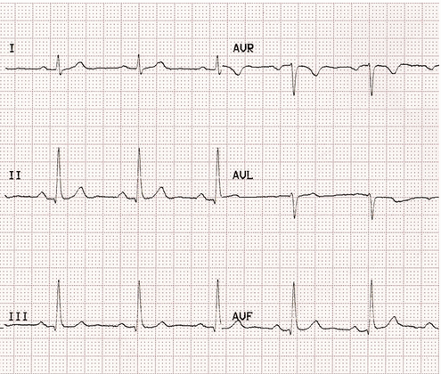 ECG cơ bản