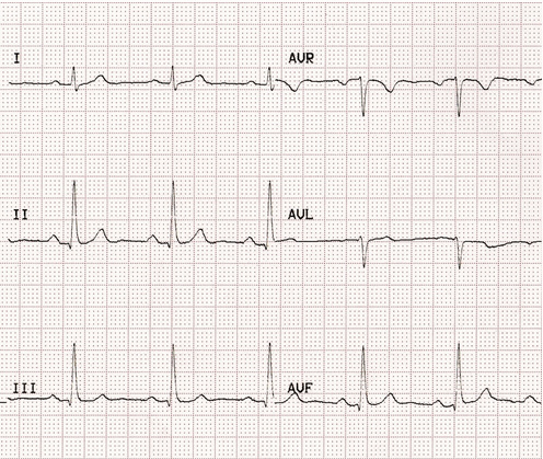 Cơ bản ECG