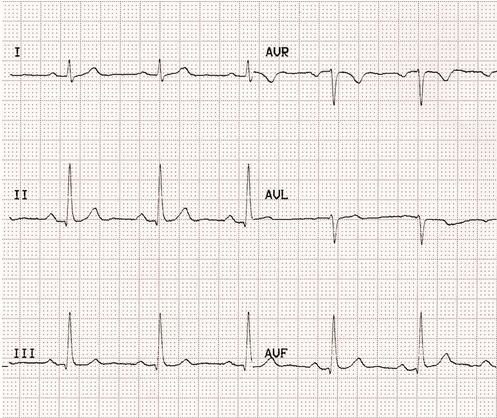 ECG cơ bản