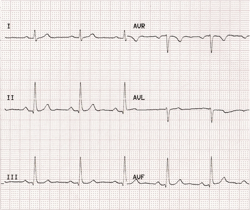 ECG cơ bản