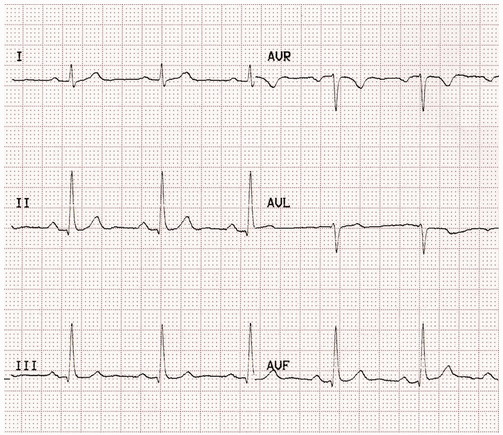 Cơ bản ECG