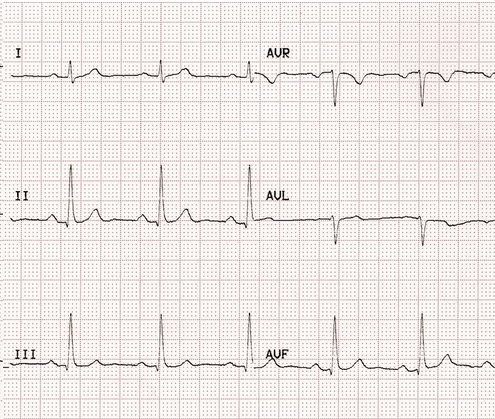 Cơ bản ECG