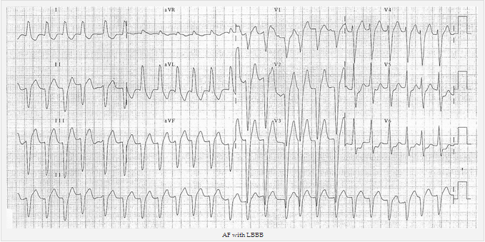 AF với LBBB