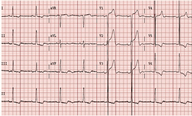 Điện áp QRS rất cao - sóng S trong V3 rất sâu