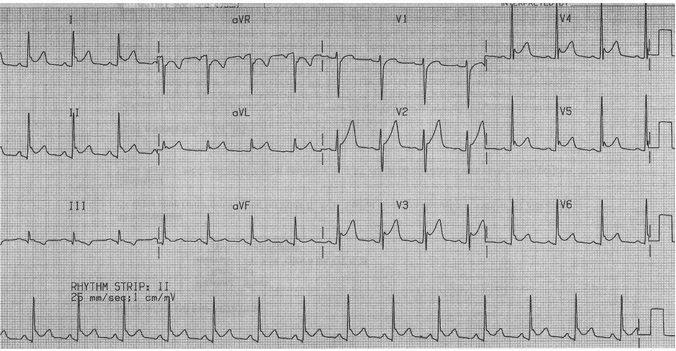 Điện tâm đồ: tái cực sớm lành tính