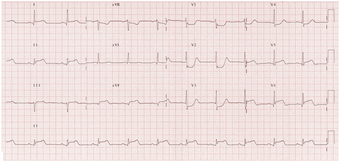 STEMI dưới bên