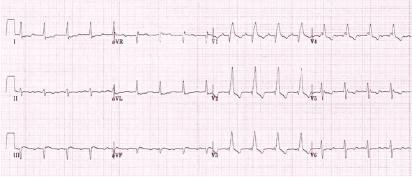 RBBB