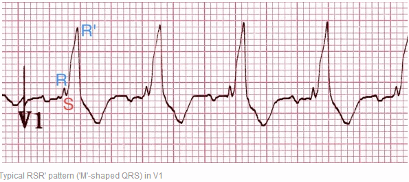 Hình điển hình RSR’ (QRS hình M) trong V1