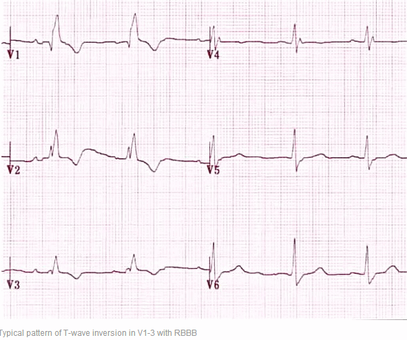 Hình điển hình sóng T đảo ngược trong V1 - 3 với RBBB