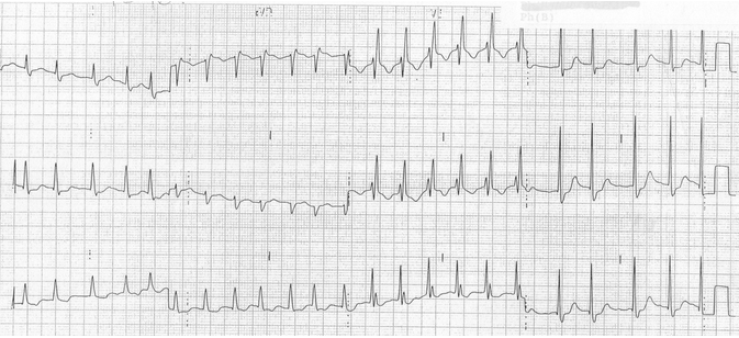 Điện tâm đồ về RBBB