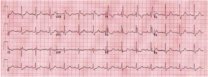 Điện tâm đồ về RBBB