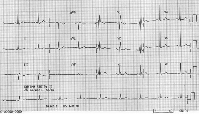 Điện tâm đồ về RBBB