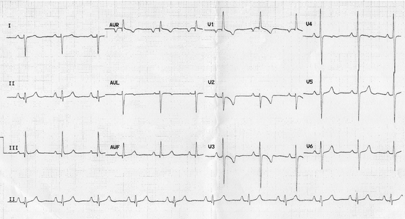 RVH ở người lớn với tứ chứng Fallot chưa sửa chữa