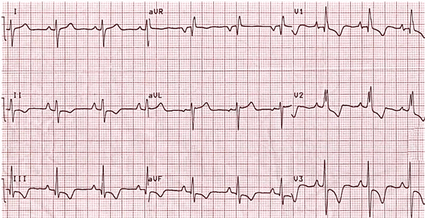 RVH ở người lớn