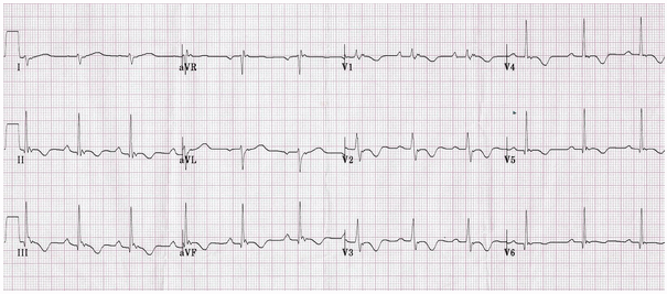 Phì đại thất phải ở bệnh nhân bị bệnh cơ tim thất phải arrhythmogenic