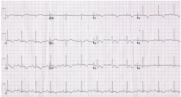 Loạn sản thất phải Arrhythmogenic