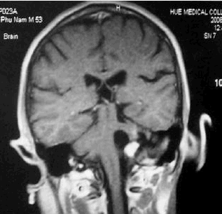 Cắt qua mặt phẳng trán trên MRI.