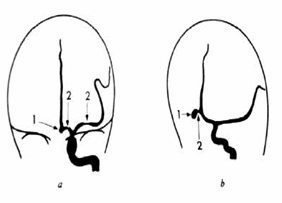 Phình động mạch não trước chụp thẳng và nghiêng