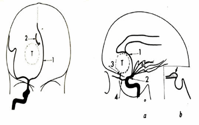 Dấu hiệu chèn đẩy mạch của u não