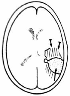 Khối u ở thái dương chẩm.