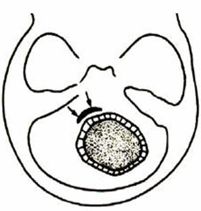 Khối u ở hố sau, đẩy lệch não thất IV.