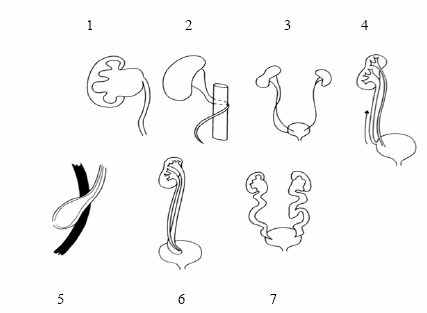 Các bất thường bẩm sinh của niệu quản