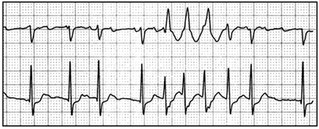 Một ví dụ về kết quả điện tâm đồ trong hiện tượng Ashma