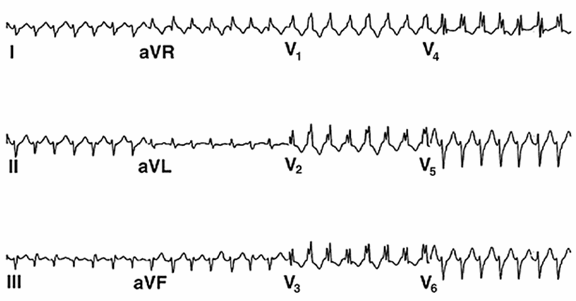 Verapamil nhạy cảm với nhịp nhanh thất 