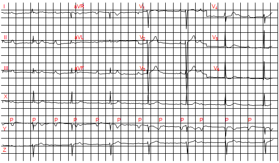 Block nhĩ thất cấp ba trên hình ảnh điện tâm đồ
