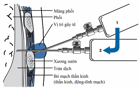 Chọc dò màng phổi