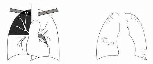 Dấu hiệu nhánh phế quản khí trong đám mờ phế bào (trái), các đường Kerley (phải).