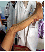 Dấu hiệu Kernig dương tính