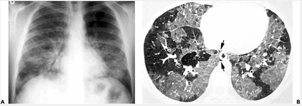 Viêm phổi pneumocystis ở bệnh AIDS