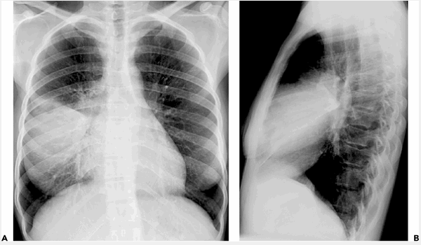 Viêm phổi thùy do Streptococcus pneumoniae
