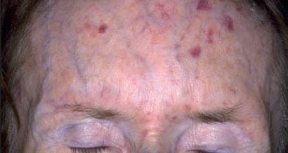 Giãn mao mạch do bệnh xơ cứng bì