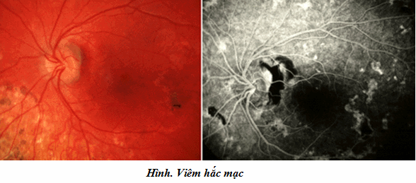 Viêm mống mắt