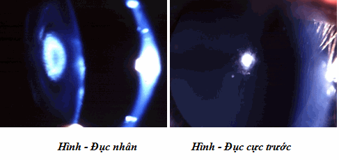 Đục thủy tinh thể