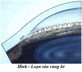 Loạn sản vùng bè