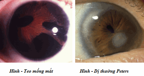 Teo mống mắt