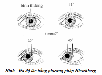 Khám lác mắt